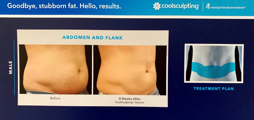 Reduce Flank Fat at Woburn, MA